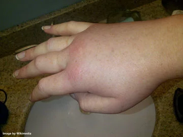 How long does swelling last after hand surgery?